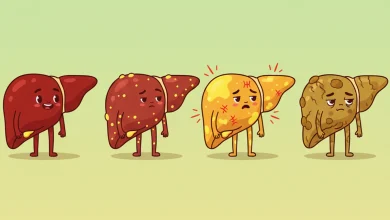 علائم و درد کبد چرب در مراحل مختلف و معرفی ۴ مرحله بیماری کبد چرب